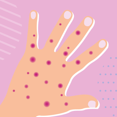 Λοιμώδη νοσήματα σε πραγματικό χρόνο PCR Monkeypox Test Kit MPXV CE Registered 1 Test/Box